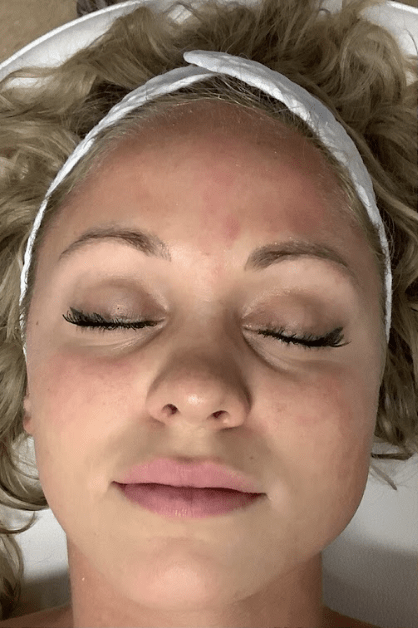 Microneedling Southern Dermatology