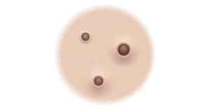 Graphic showing what blackheads look like.