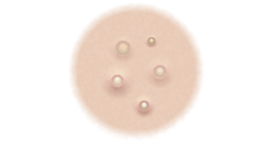 Graphic showing what cystic acne looks like.