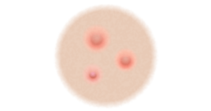 Graphic showing what papules look like.