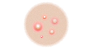 Graphic showing what postules look like.