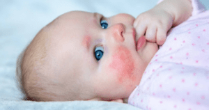 A baby girl with red spots on her face peacefully rests on a bed, showcasing her adorable innocence.