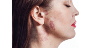 A woman with birthmarks on her face.