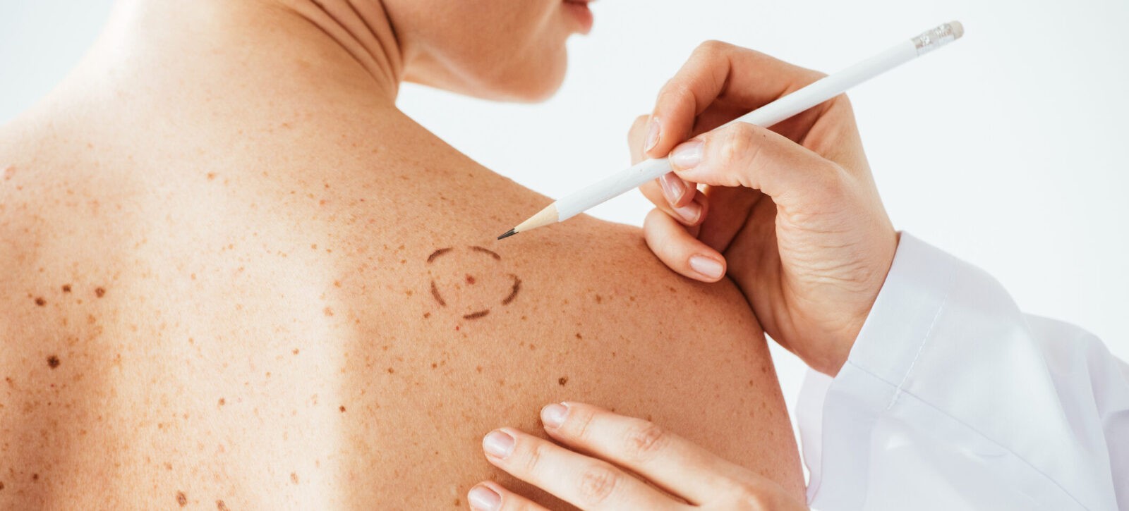cropped view of dermatologist applying marks on skin of naked woman with melanoma isolated on white
