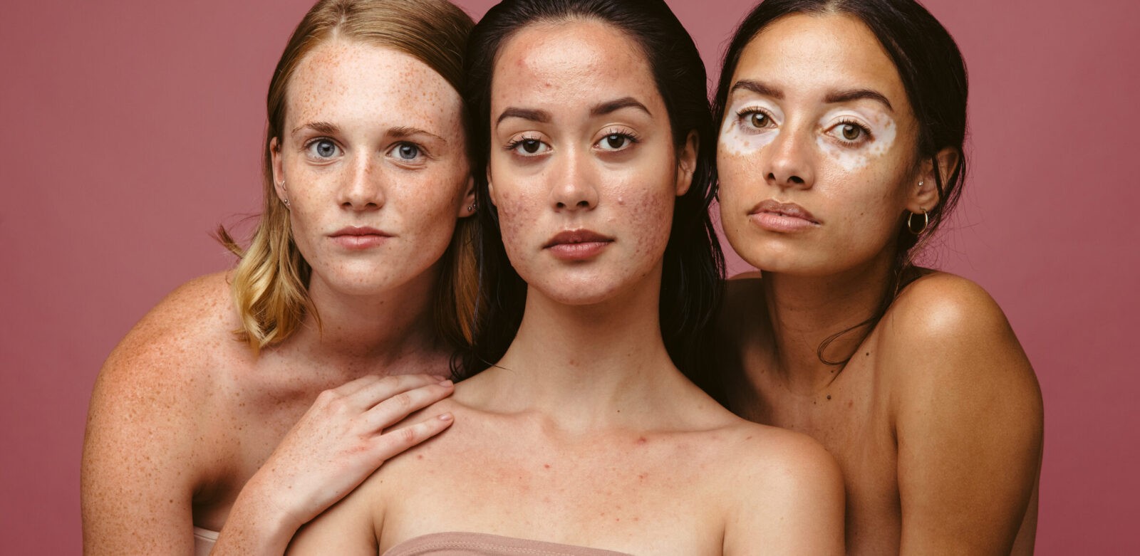 Portrait of three confident women with common skin conditions on pink background.
